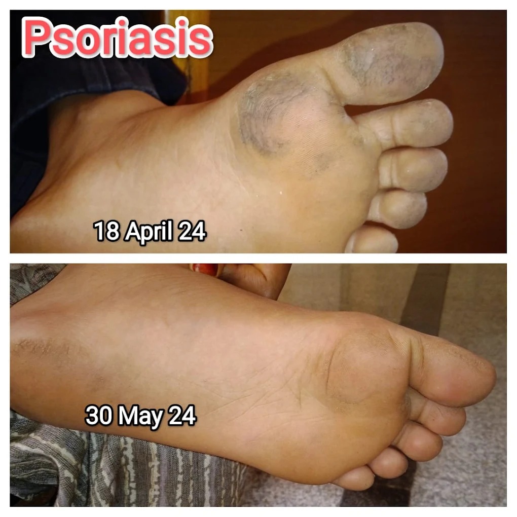 Plantar Psoriasis Healing